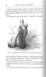 Fig. 4. Hypertrophie congénitale du 2e orteil et lipome plantaire - Titres et travaux scientifiques