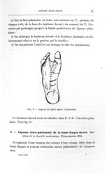 Fig. 6. Aspect du pied après l'opération - Titres et travaux scientifiques