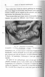 Fig. 12. Appendicite et diverticulite - Titres et travaux scientifiques