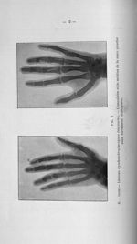 Fig. 6. G... Anne. - Lésions dyschondroplasiques des mains. - L'annulaire et le médius de la main ga [...]