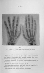 Fig. 7. P..., 6 ans. - La main droite seule présente des lésions - Titres et travaux scientifiques