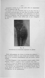 Fig. 13. Ostéosarcome de l'extrémité supérieure du péroné - Titres et travaux scientifiques