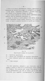 Fig. 15. Hypertrophie maligne de la prostate - Titres et travaux scientifiques