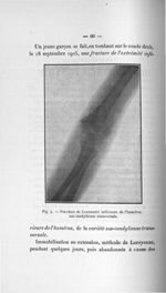 Fig. 4. Fracture de l'extrémité inférieure de l'humérus, sus-condylienne transversale - Titres et tr [...]