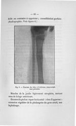 Fig. 6. Fracture du tibia 1/3 inférieur, transversale sous-périostée - Titres et travaux scientifiqu [...]
