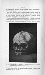 Fig. 2. Crâne emprunté à la collection de la Clinique d'accouchements du professeur Fochier et se ra [...]