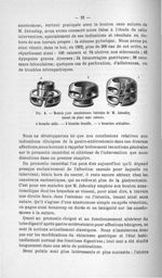 Fig. 4. Bouton pour anastomoses latérales de M. Jaboulay, tenant en place sans sutures - Titres et t [...]