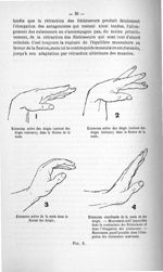 Fig. 6. 1. Extension active des doigts (surtout des doigts externes) / 2. Extension active des doigt [...]