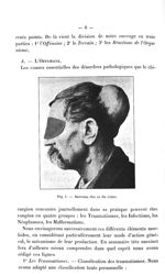 Fig. 1. Sarcome des os du crâne - Titres et travaux