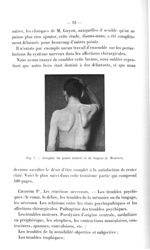 Fig. 7. Atrophie du grand dentelé et du trapèze (A. Mouchet) - Titres et travaux