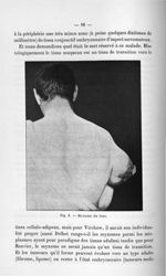 Fig. 8. Myxome du bras - Titres et travaux