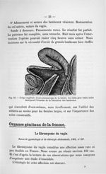 Fig. 12. Coupe sagittale demi-schématique de la fistule - Titres et travaux