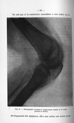 Fig. 21. Radiographie montrant le déplacement cunéen de la rotule pendant la flexion - Titres et tra [...]