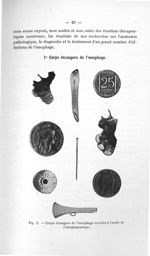 Fig. 2. Corps étrangers de l'oesophage extraits à l'acide de l'oesophagoscope - Titres et travaux sc [...]
