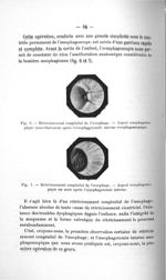 Fig. 6. Rétrécissement congénital de l'oesophage. - Aspect oesophagoscopique immédiatement après l'o [...]