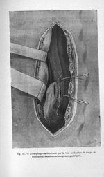 Fig. 17. L'oesophago-gastrostomie par le voie médiastine (4e temps de l'opération. Anastomose oesoph [...]