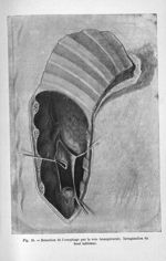 Fig. 18. Résection de l'oesophage par la voie transpleurale. Invagination du bout inférieur - Titres [...]