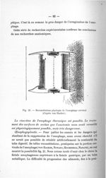 Fig. 21. Reconstitution plastique de l'oesophage cervical (d'après von Hacker) - Titres et travaux s [...]