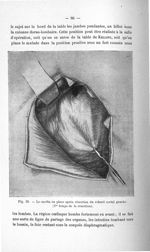 Fig. 23. Le cardia en place après résection du rebord cortal gauche. (1er temps de la résection) - T [...]