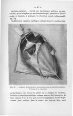 Fig. 24. Ligature de la corolaire stomachique dans sa portion ascendante. (2e temps de la résection) [...]