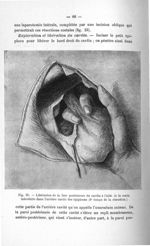 Fig. 25. Libération de la face postérieure du cardia à l'aide de la main, introduite dans l'arrière  [...]