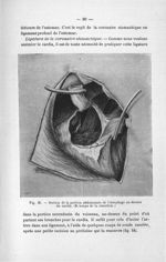 Fig. 26. Section de la portion abdominale de l'oesophage au-dessus du cardia. (4e temps de la résect [...]
