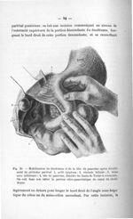 Fig. 30. Mobilisation du duodénum et de la tête du pancréas après décollement du péritoine pariétal  [...]