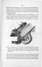 Fig. 31. Drainage, par la voie lombaire de la région cholédochienne - Titres et travaux scientifique [...]