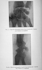 Fig. 7. Type de radiographie de face d'une luxation du 1er groupe avec fracture du scaphoïde / Fig.  [...]