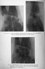 Fig. 9 et 10. Face et profil d'une luxation du 1er groupe avec fracture du scaphoïde avant la réduct [...]