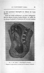 Fig. 5. (Pl. XLIII. - Atlas Pinard et Varnier) - Concours d'agrégation, chirurgie et accouchements,  [...]