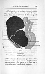 Fig. 6. Rétroversion de l'utérus gravide au 5e mois, avec rétention d'urine (schématique) - Concours [...]
