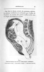 Fig. 7. Tracé des incisions des diverses embryotomies rachidiennes - Concours d'agrégation, chirurgi [...]