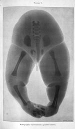 Radiographie d'un hémisome (grandeur nature) - Concours d'agrégation, chirurgie et accouchements, 19 [...]