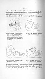 Fig. 14. Cas de B. Anger et Thomas. - Vue antérieure des os dénudés des ligaments / Fig. 15. Cas de  [...]