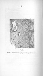 Fig. IX. Obs. 2. Végétations extra-kystiques envahies par la tuberculose - Titres et travaux scienti [...]