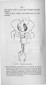 Fig. III. Manoeuvre combinée - Concours pour l'agrégation, 1907, section de chirurgie et accouchemen [...]