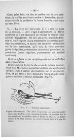 Fig. V. Traction unilatérale - Concours pour l'agrégation, 1907, section de chirurgie et accouchemen [...]