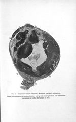 Fig. 4. Grossesse tubaire isthmique. Embryon long de 5 millimètres. Coupe histologique du sac, perpe [...]