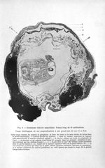Fig. 6. Grossesse tubaire ampullaire. Foetus long de 35 millimètres - Titres et travaux scientifique [...]