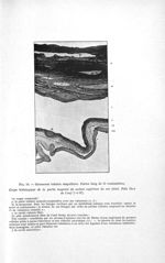 Fig. 10. Grossesse tubaire ampullaire - Titres et travaux scientifiques