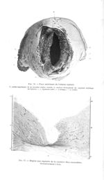 Fig. 16. Face antérieure de l'utérus rupturé / Fig. 17. Région non rupturée de la cicatrice fibro-mu [...]