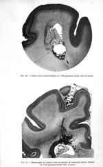 Fig. 24. Foyer sous-cortical (Enfant de 1.500 grammes ayant vécu 18 jours) / Fig. 25. Hémorragie du  [...]