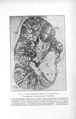Fig. 40. Coupe histologique totale d'un rein polykystique - Titres et travaux scientifiques
