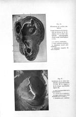 Fig. 46. Hématome du cordon ombilical / Fig. 47. Déchirure de la veine ombilicale - Titres et travau [...]