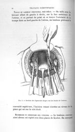 Fig. 1. Section des ligaments larges sur les bords de l'utérus - Titres et travaux scientifiques