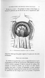 Fig. 6. Péritonisation complétée à l'aide de l'intestin - Titres et travaux scientifiques