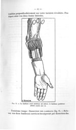Fig. 8. Le lambeau carré antérieur et relevé ; le lambeau postérieur adhère encore aux os - Avril 19 [...]