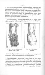 Fig. 9. Les deux lambeaux sont disséqués et les os sciés / Fig. 10. Le moignon est suturé - Avril 19 [...]