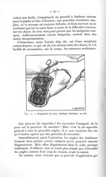 Fig. 11. Amputation du bras ; lambeau disséqués ; os scié - Avril 1907. Titres et travaux scientifiq [...]
